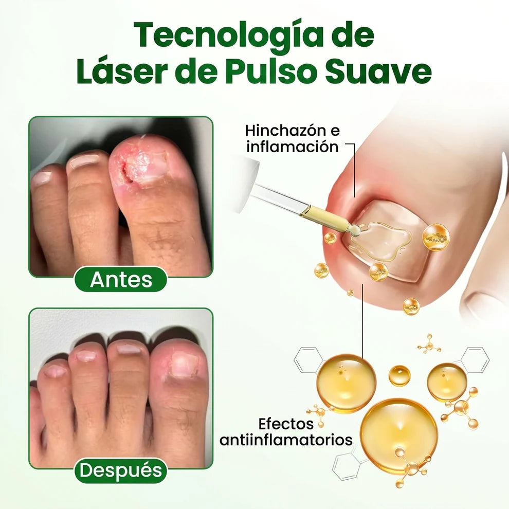 Tratamiento Anti Hongos - en Uñas Amarillas y las Fortalece desde 7 Días