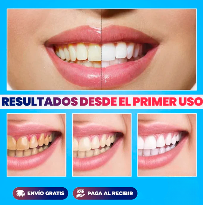 SonrisaBrillante - Kit Blanqueador UV - [PROMOCIÓN DISPONIBLE SOLO HOY]